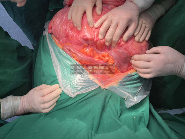 В Плевен хирурзи извадиха 26-килограмов тумор от корема на пациент