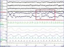 Sleep Changes in Extreme Weather Studied during Bulgarian Antarctic Expedition