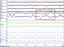 Sleep Changes in Extreme Weather Studied during Bulgarian Antarctic Expedition